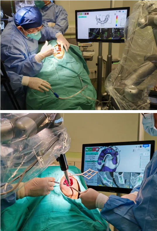 上半口机器人种植手术在上海一医院顺利完成